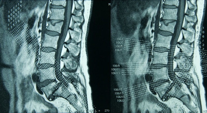 lumbar spine mri